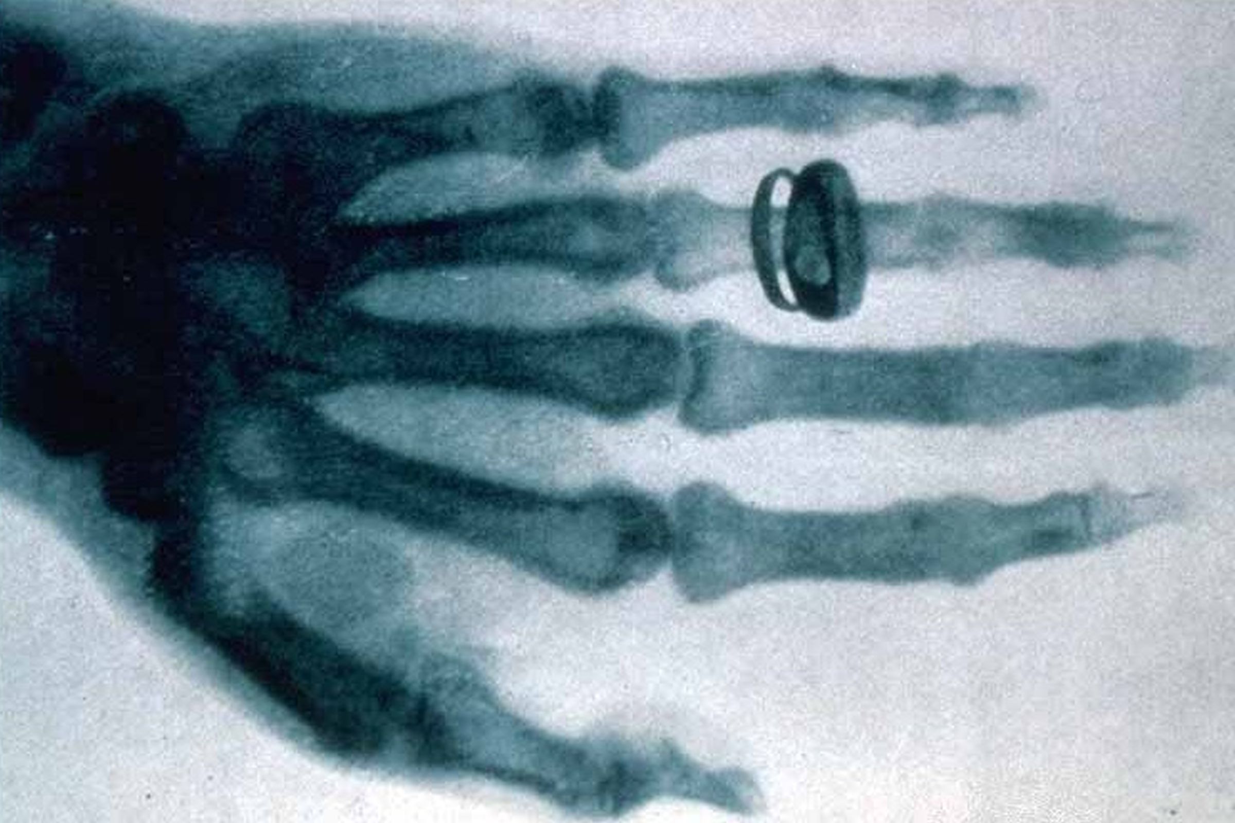 X-ray picture of the hand of Albert von Kölliker taken by Wilhelm Röntgen