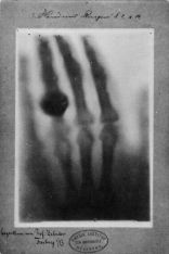 Anna Röntgens Hand, aufgenommen von ihrem Mann am 22. Dezember 1895